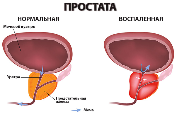 prostatita turgenevskaya fireweed de la prostatită